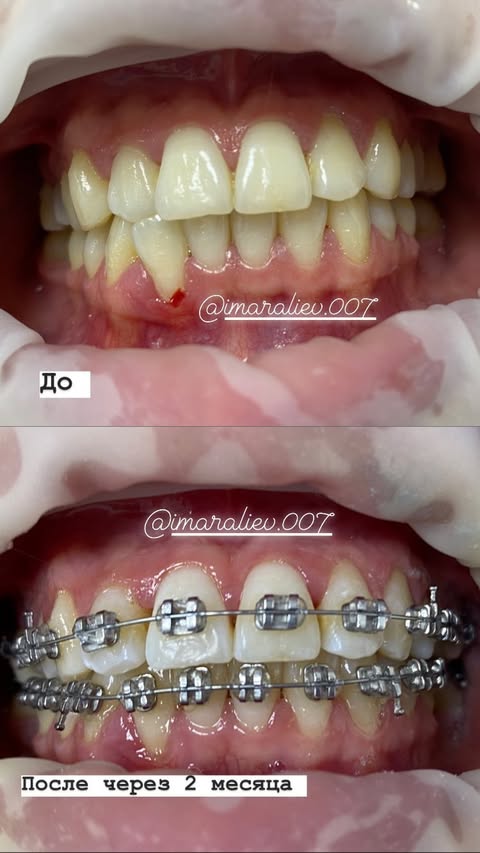 Процесс ортодонтического лечения