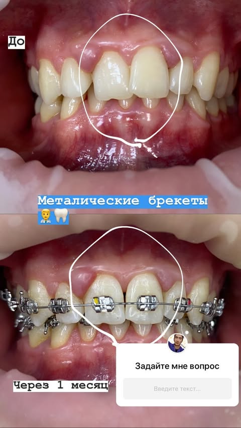 Металлические брекет-системы