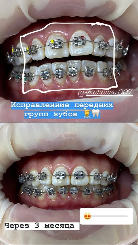 Брекеты с разноцветными резинками