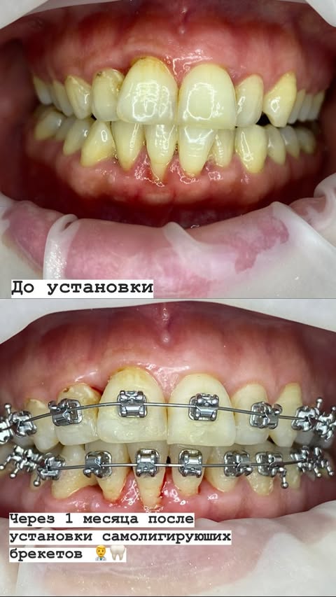 Этап лечения брекетами
