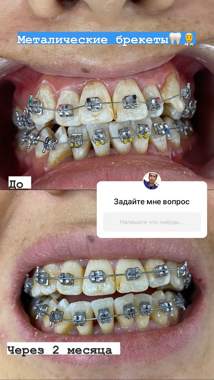 Лечение нарушений прикуса