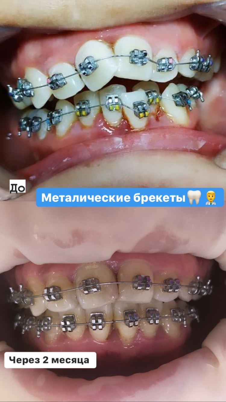 Брекеты финиш — кейс 2