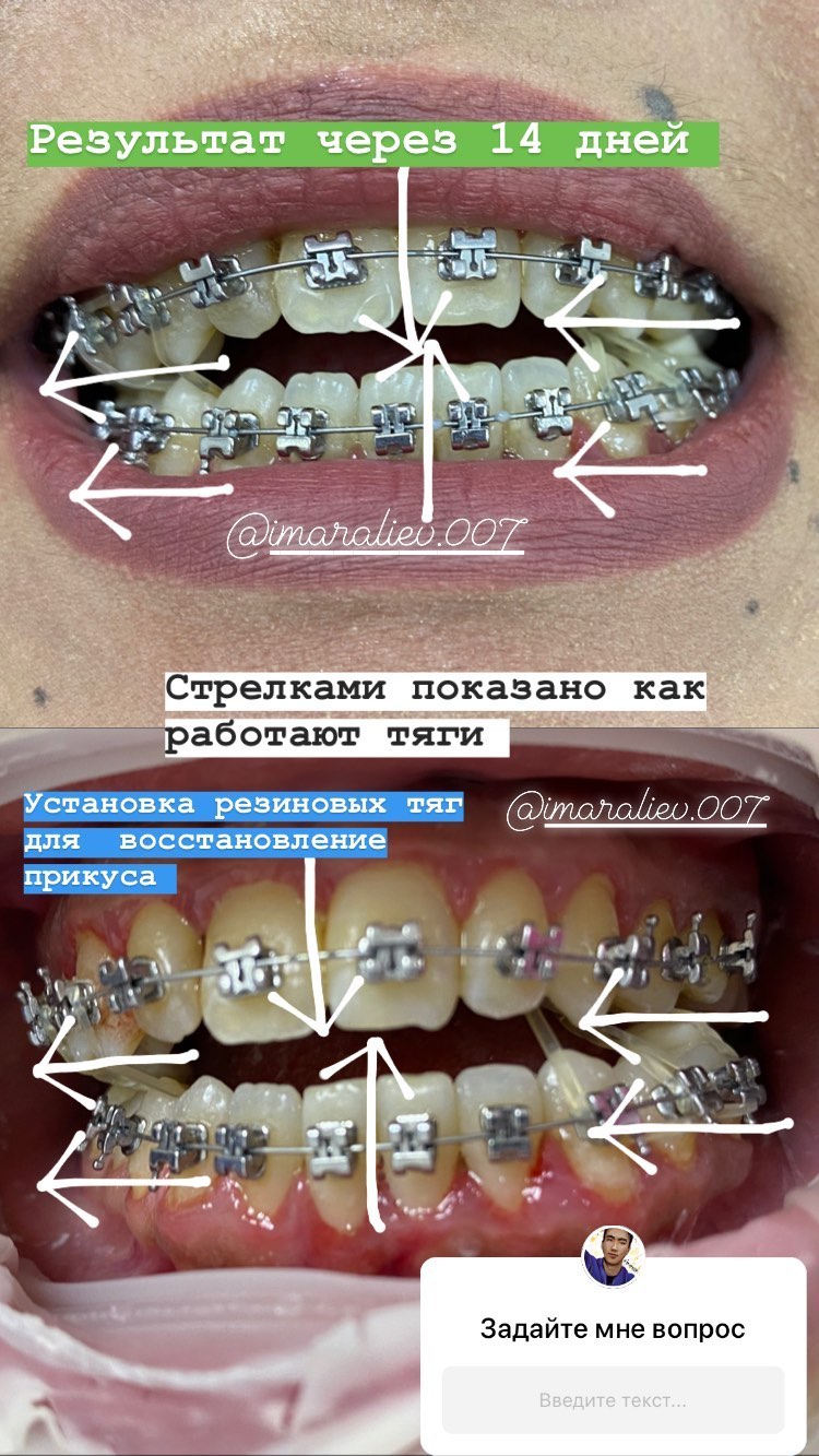 Брекеты финиш — кейс 5