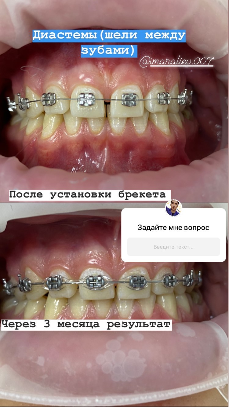 Брекеты финиш — кейс 6