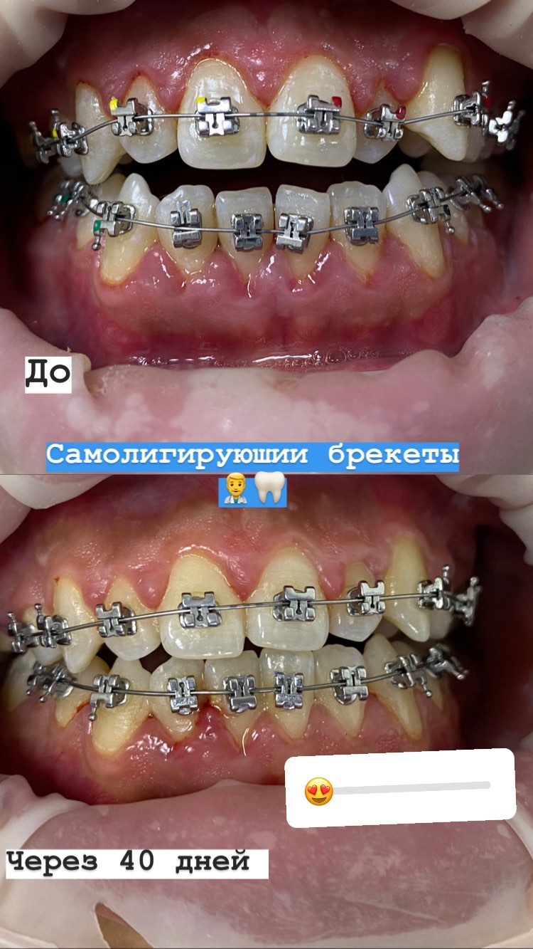 Брекеты финиш — кейс 7