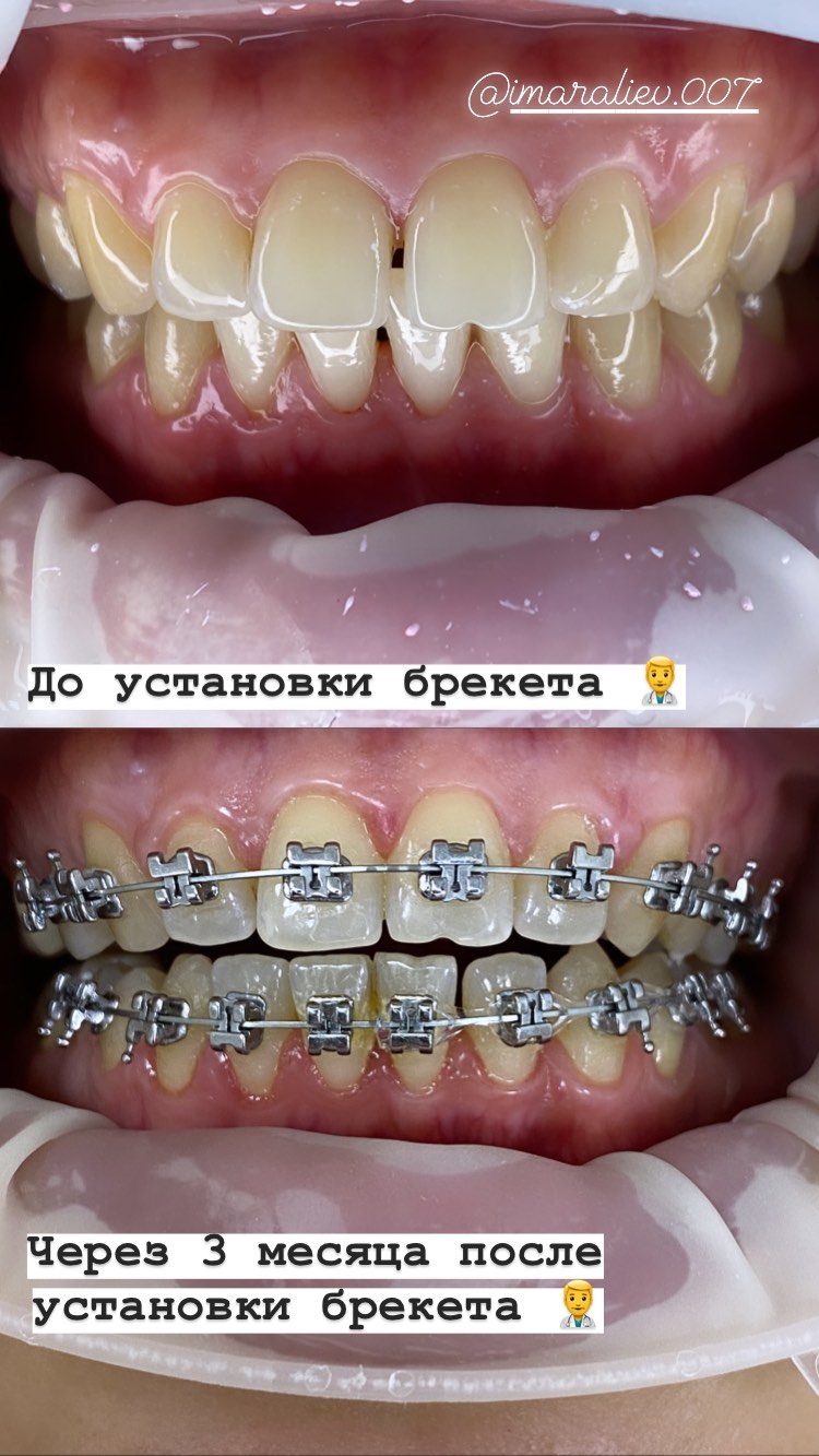 Брекеты финиш — кейс 9