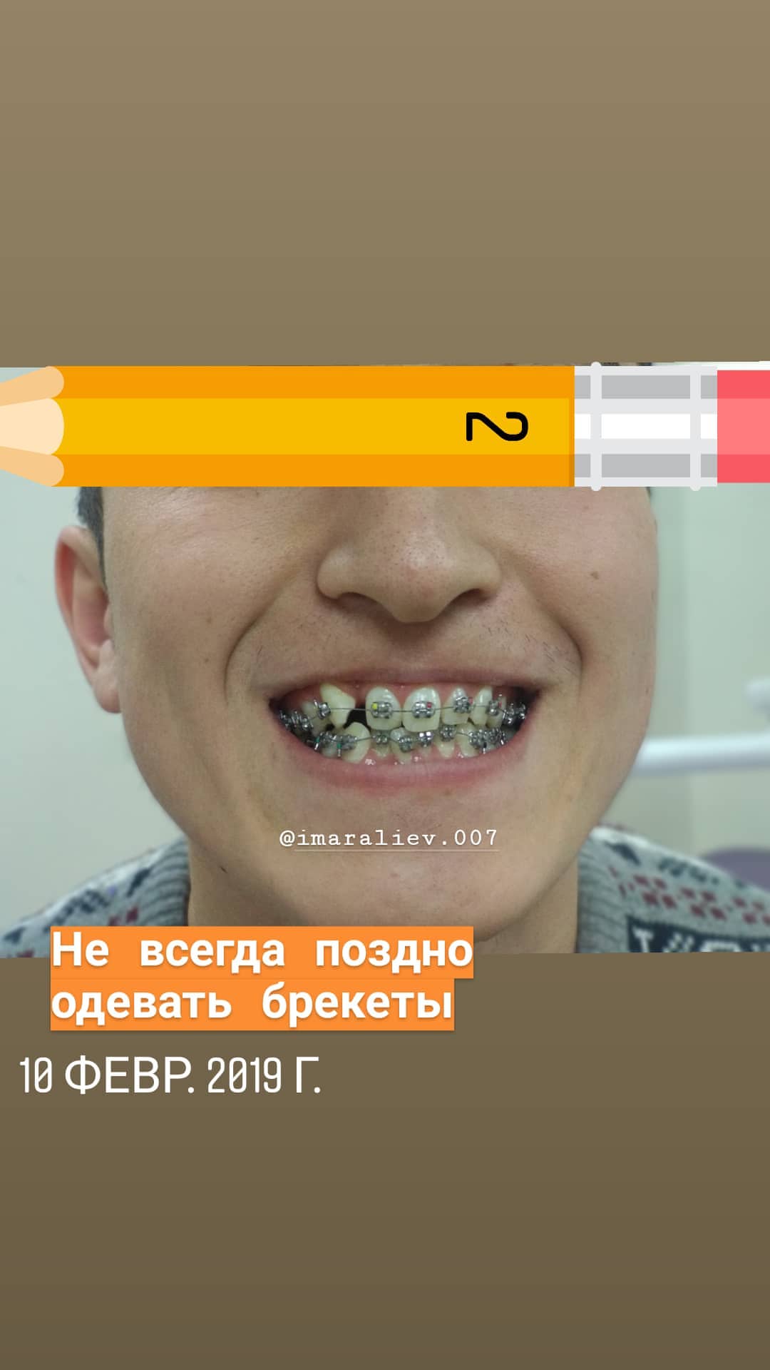 Брекеты — кейс 10