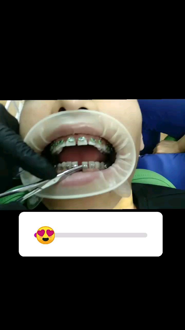 Брекеты — кейс 2