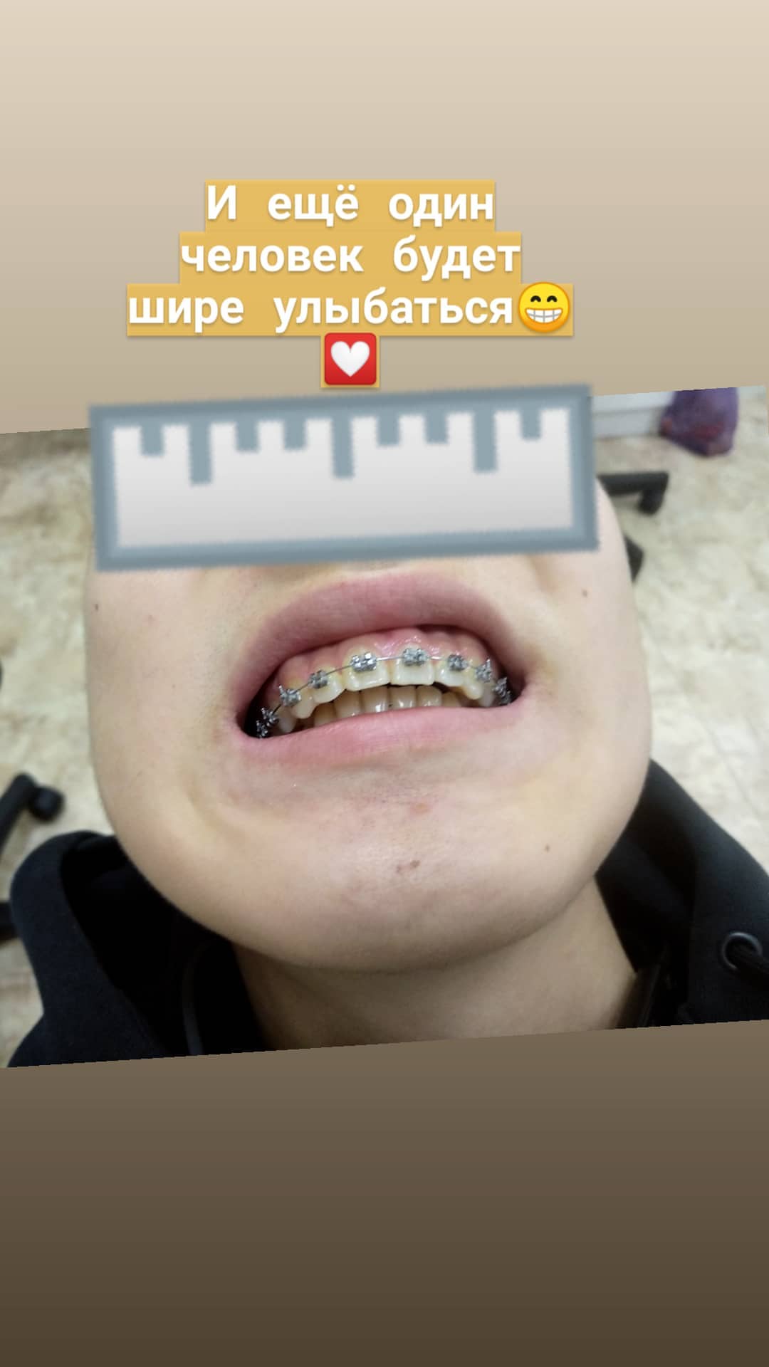 Брекеты — кейс 3