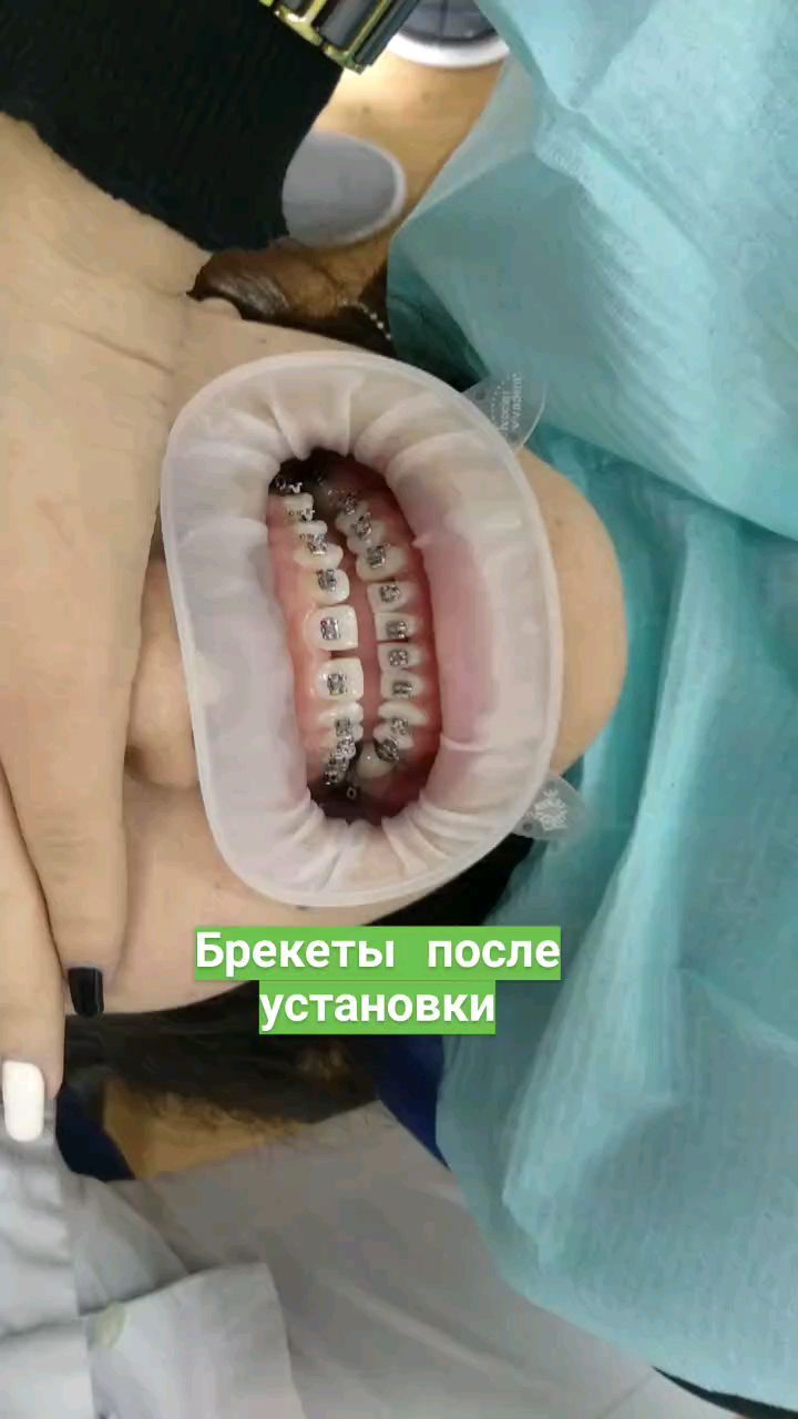 Брекеты работа