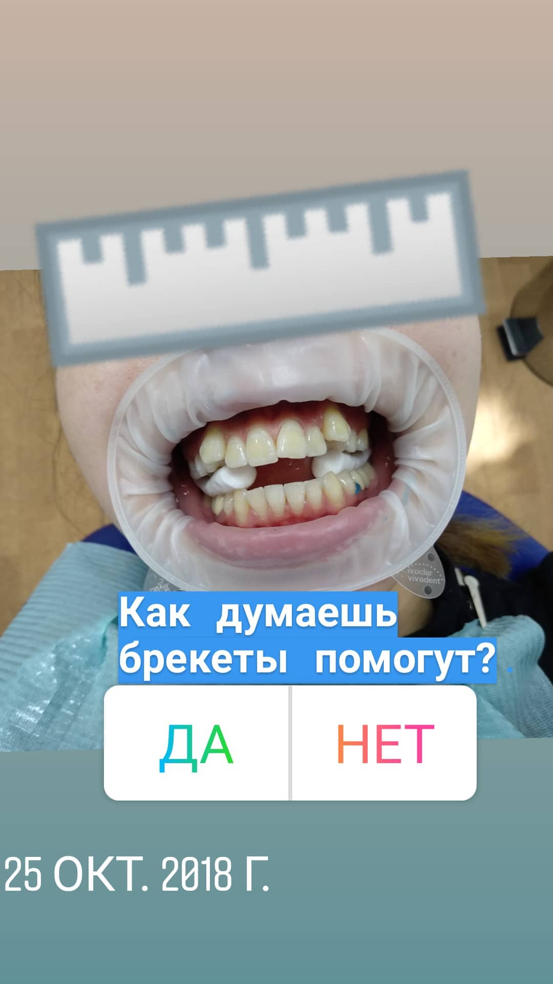Брекеты — кейс 5