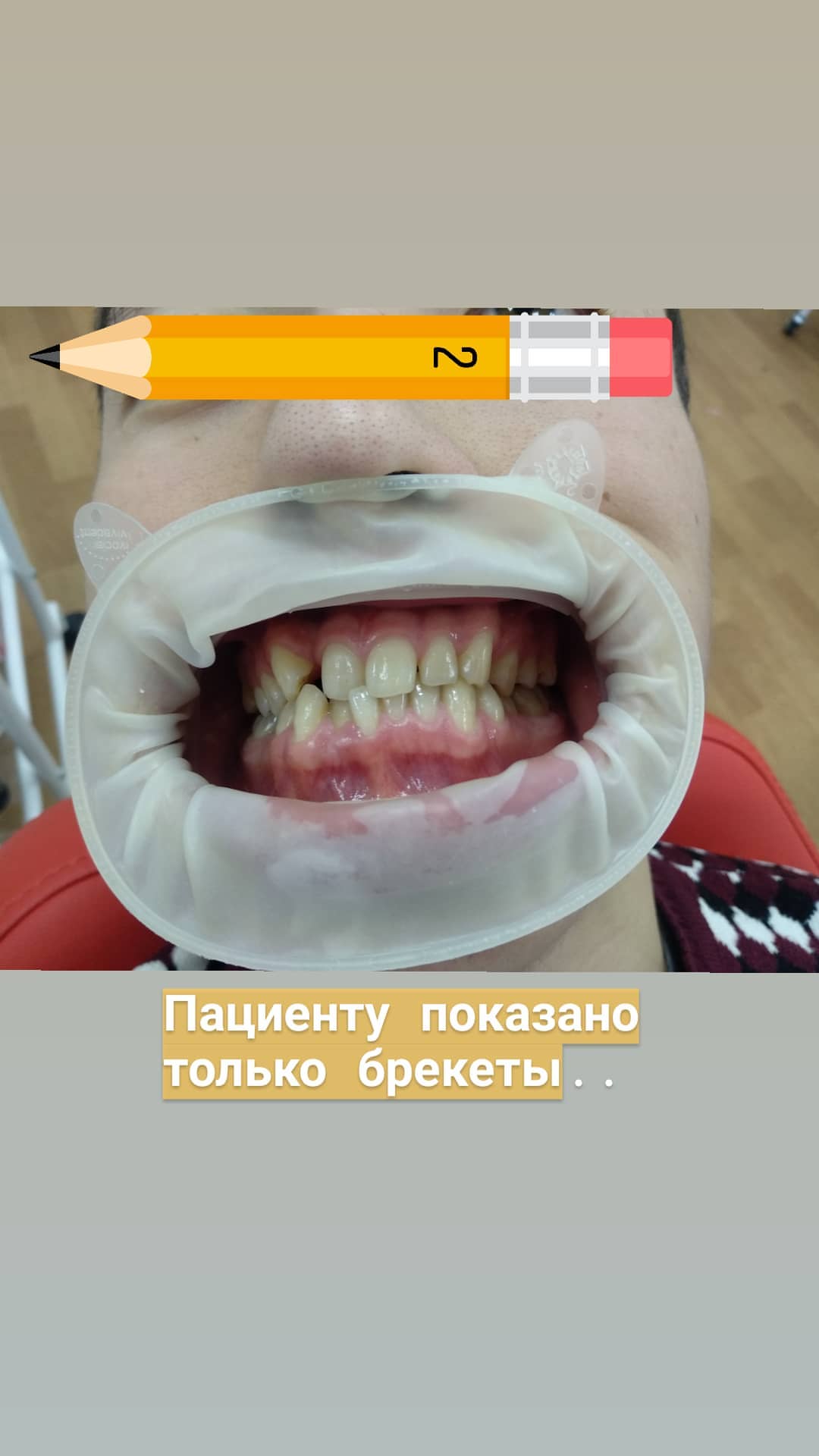 Брекеты — кейс 6