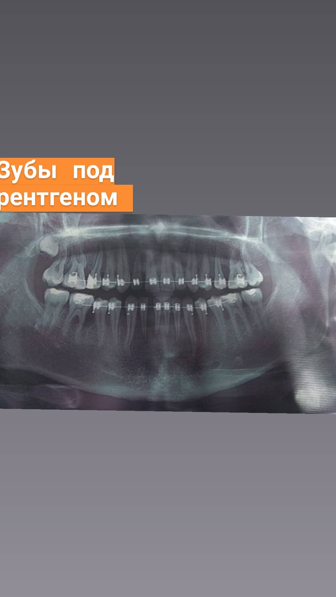 Брекеты — кейс 7