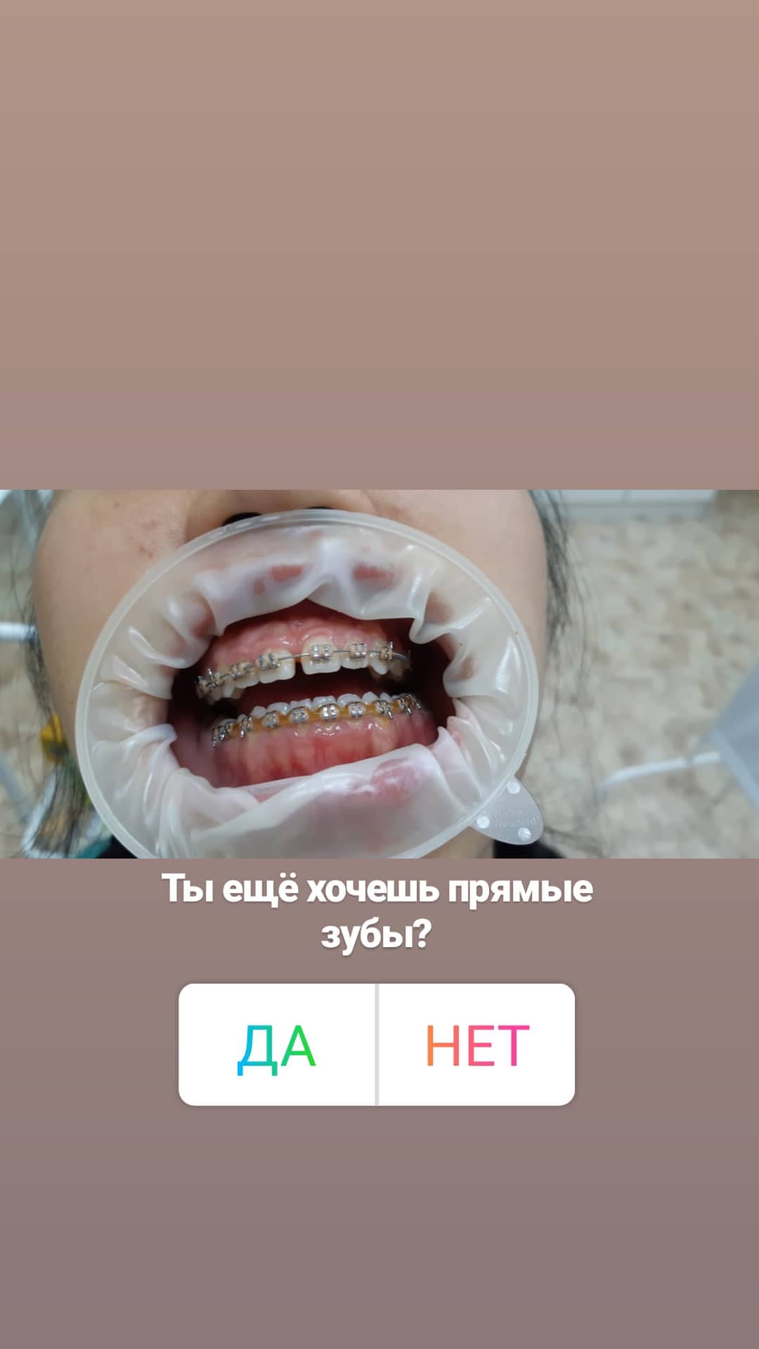 Брекеты — кейс 8