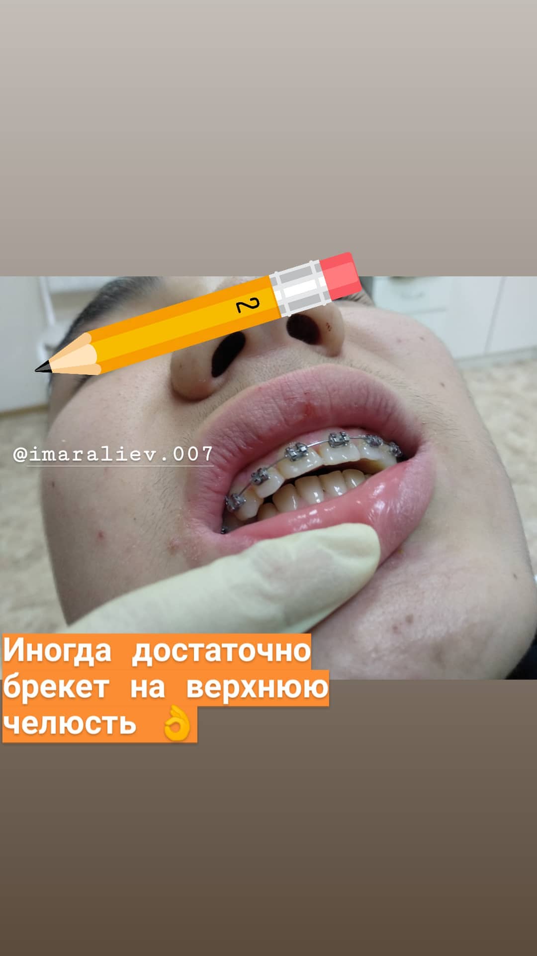 Брекеты — кейс 9