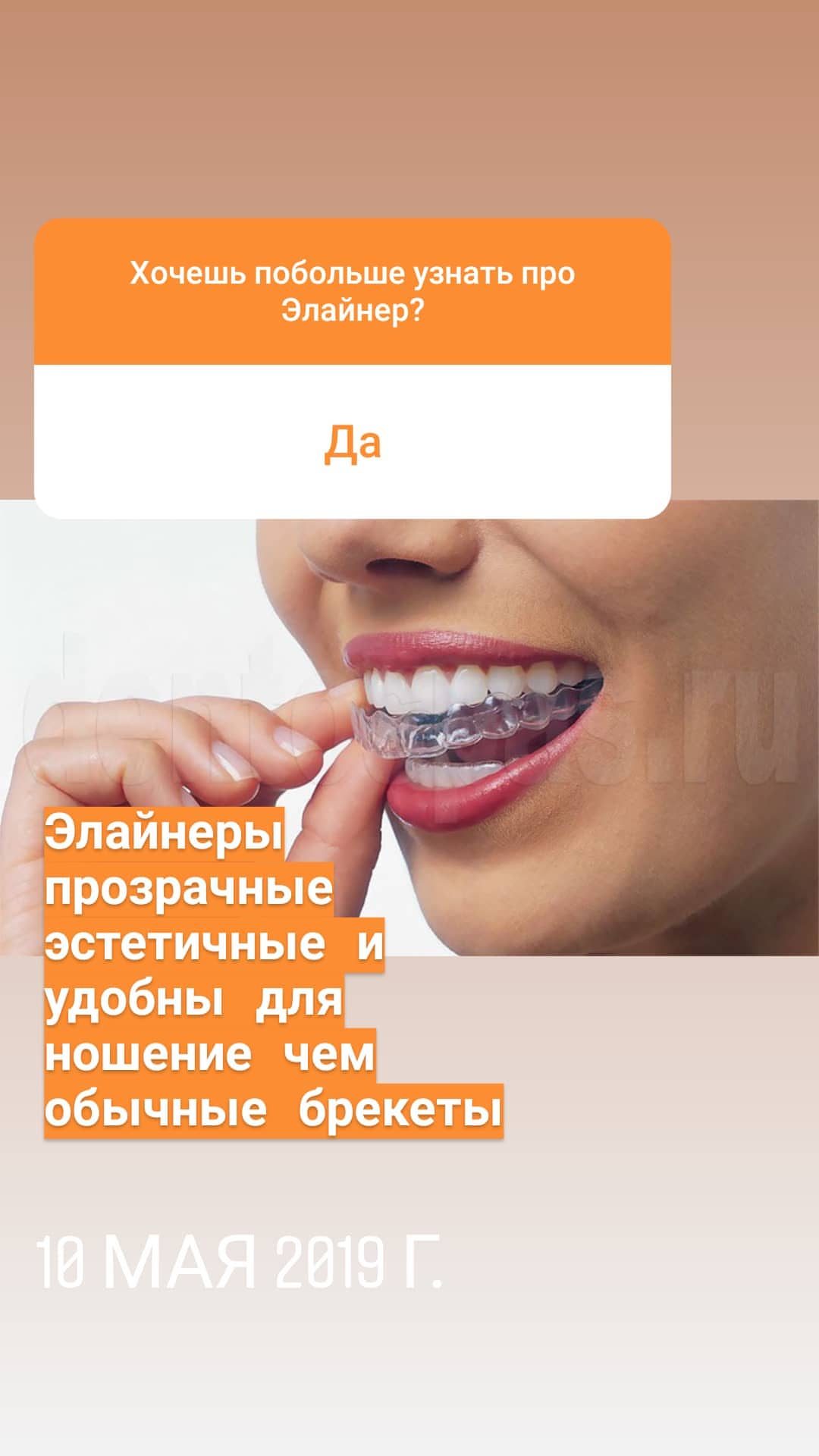 Элайнеры — кейс 1