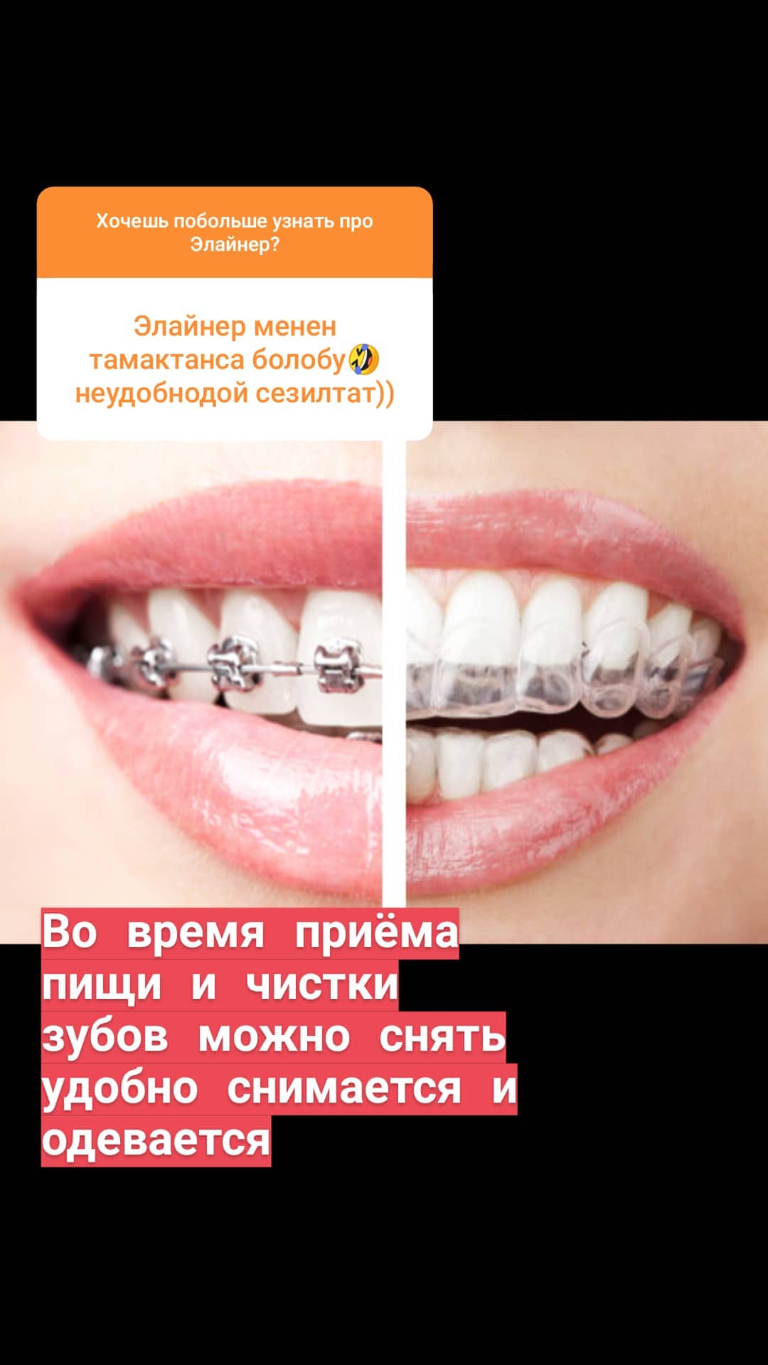 Элайнеры — кейс 2