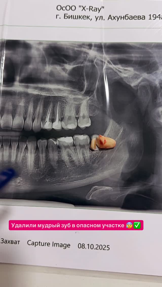 Удаление зубов