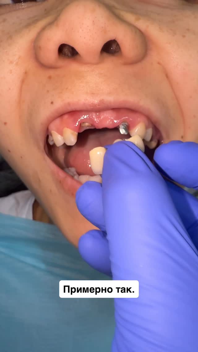 Восстановление зубов