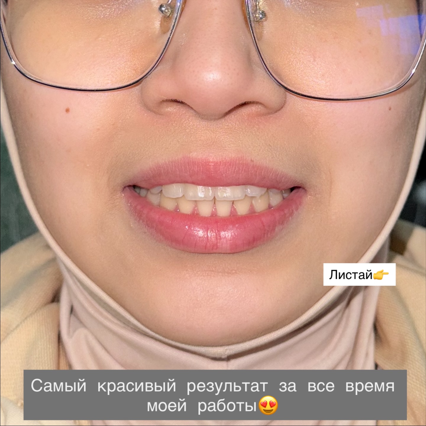 Результат ортодонтического лечения — красивая улыбка