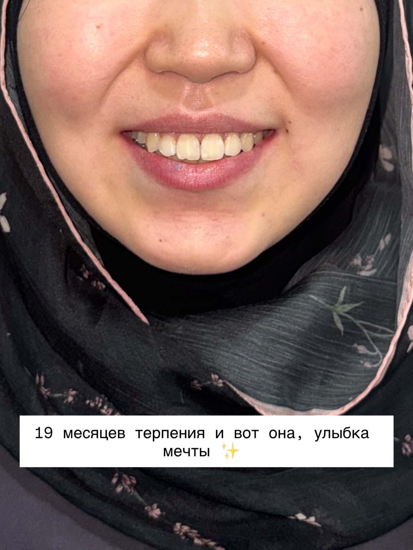 До и после — скученность зубов, 26 лет, 19 месяцев