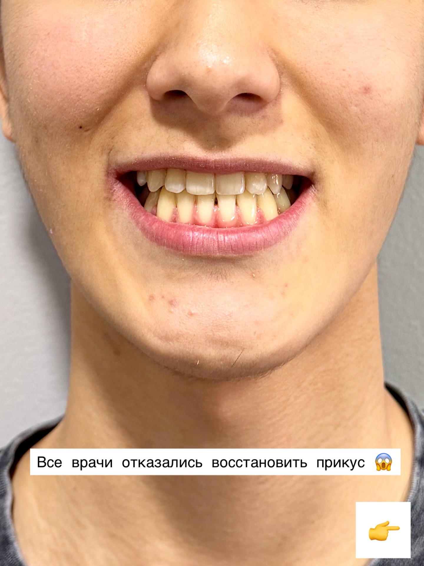 До и после — прогенический прикус, 16 лет, 17 месяцев лечения